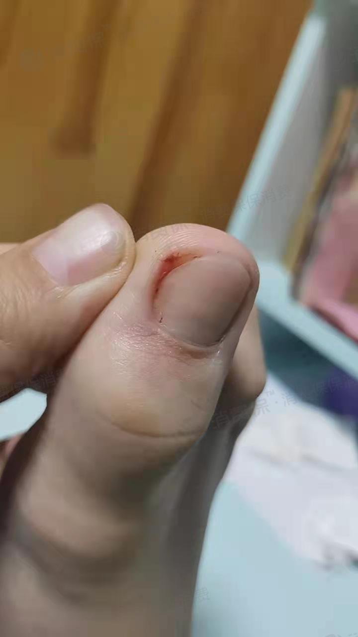 服务过程中,一阵疼痛,发现脚趾甲出血.