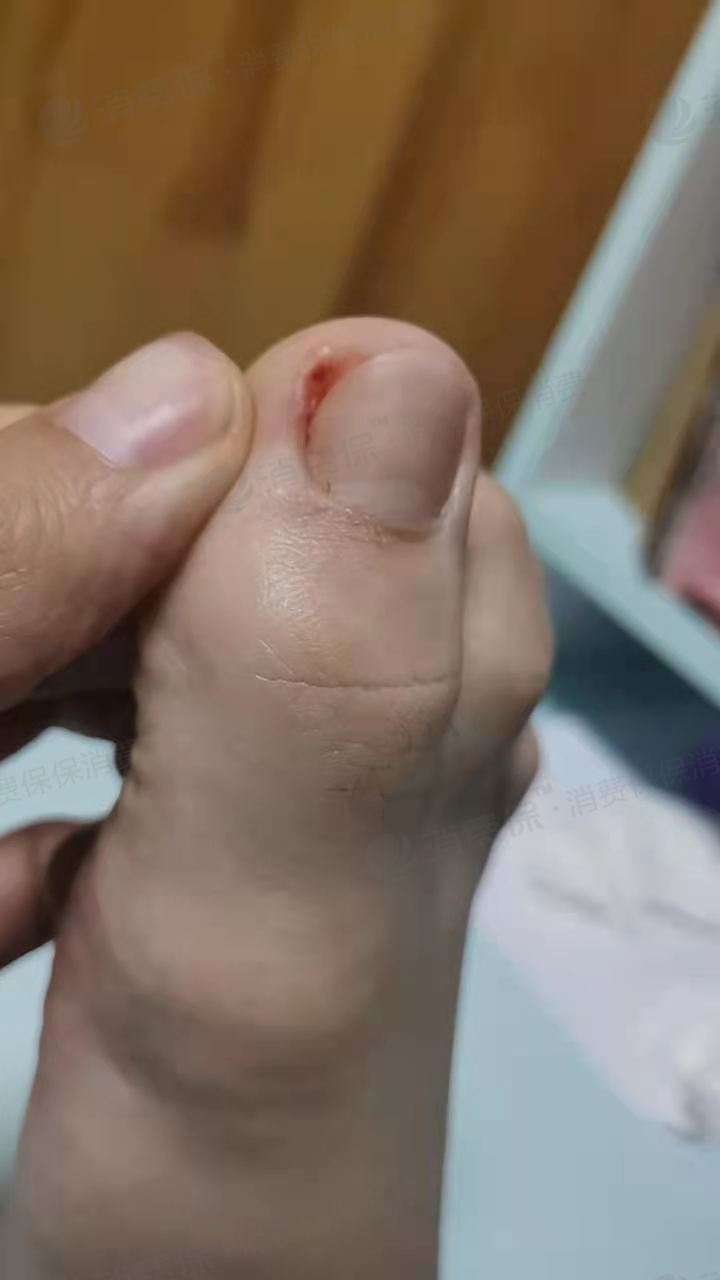 服务过程中,一阵疼痛,发现脚趾甲出血.